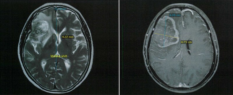 双特异性抗体治疗对抗难治肺癌 双特异性抗体治疗对抗难治肺癌